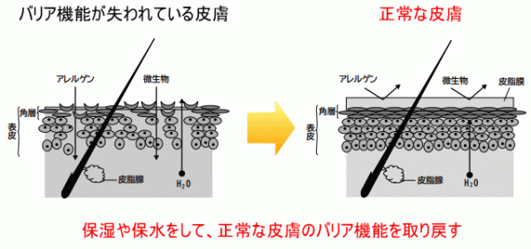 アトピー性皮膚炎について考えるサムネイル